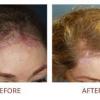 Palm Desert Hair Transplant - Palm Desert Business Directory